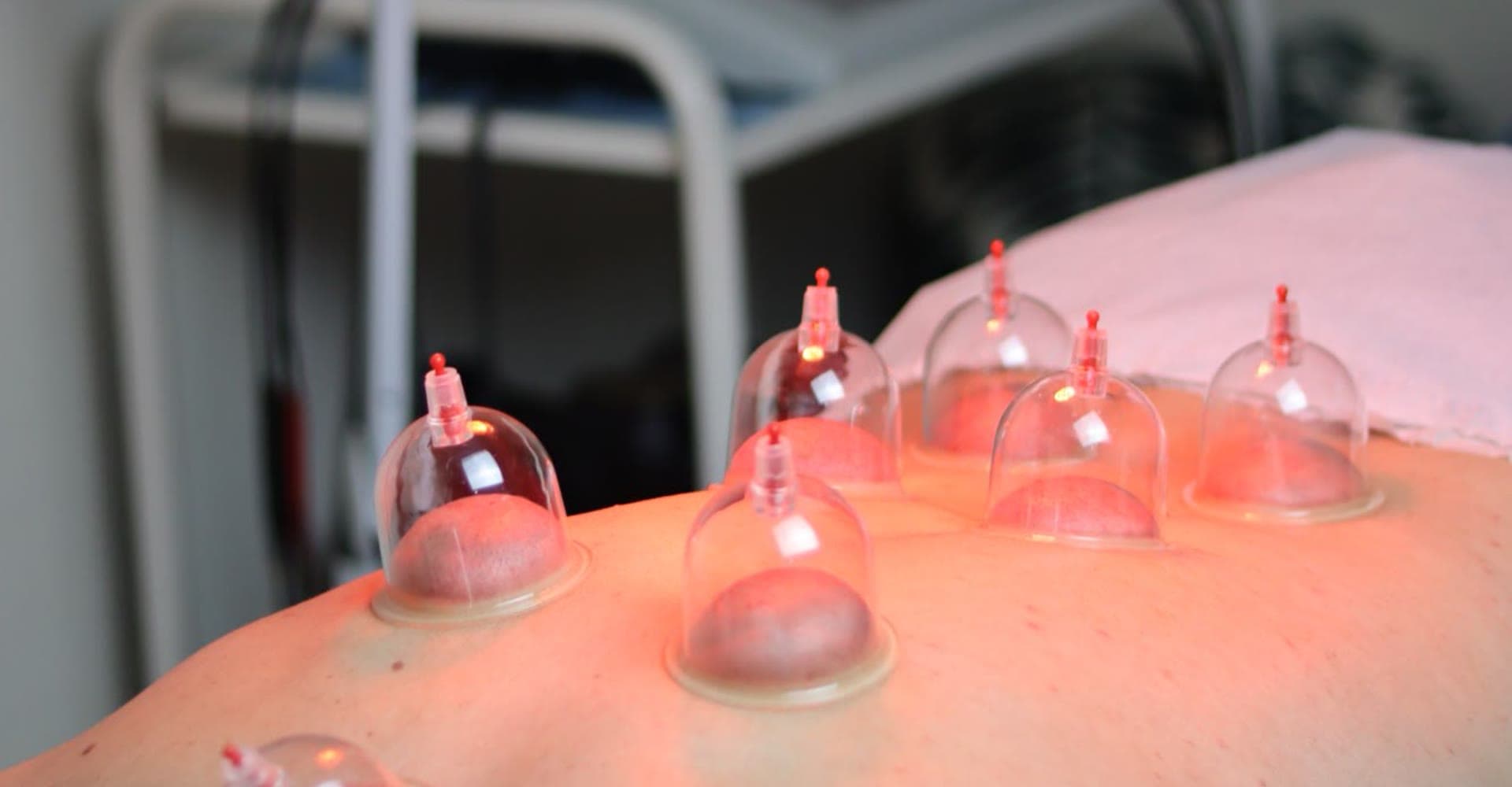 Hijama médicale
